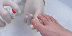 nail fungus is how to treat it