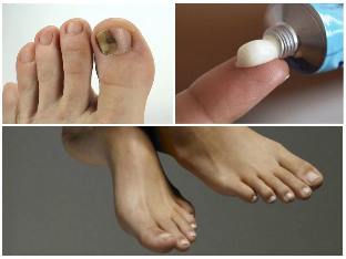 the nail fungus on the feet with the ointment