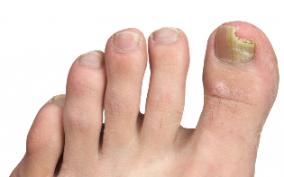 the nail fungus on the feet, the stage of the