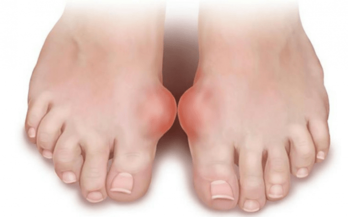foot deformities as a cause of the appearance of fungus on the feet