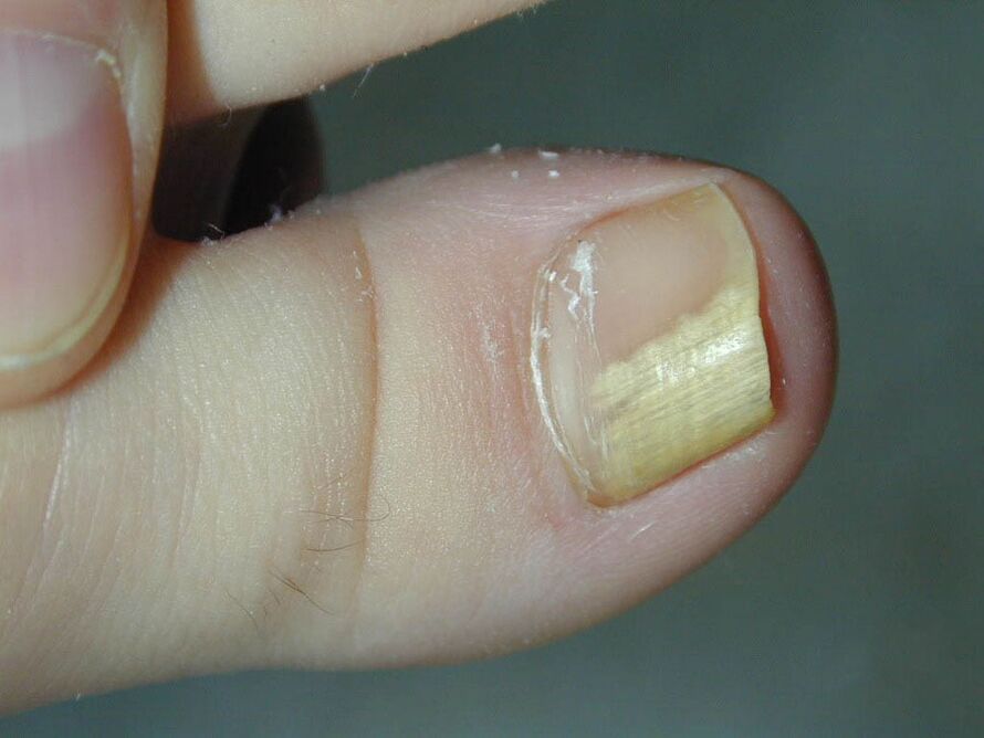 Symptoms of fungus - discoloration of the nails