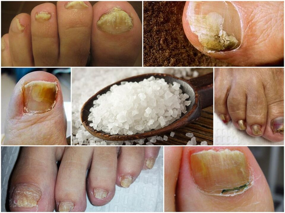 The struggle against the fungus