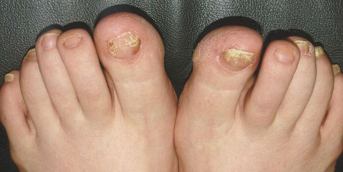 Onychomycosis of the nails in the foot