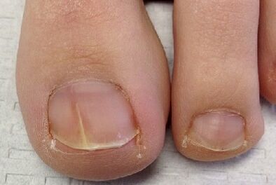 Fingernail fungus
