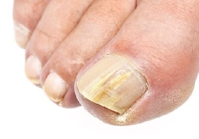 Like what nail fungus