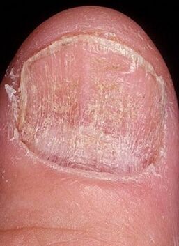 Nail mycosis