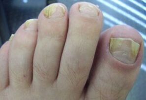 Affected by nails with fungal infections