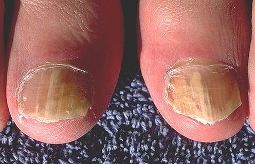 Nails affected by dermatofit