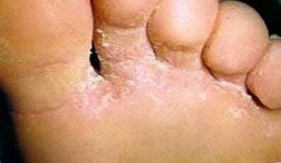 How to recognize a fungus in the finger