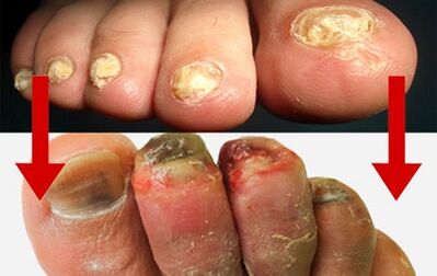 Manifestation of fungus in the finger