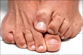 itching on the skin of the feet due to fungal nail infection