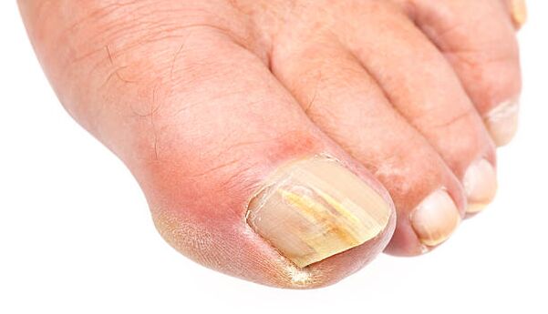 toenail fungus