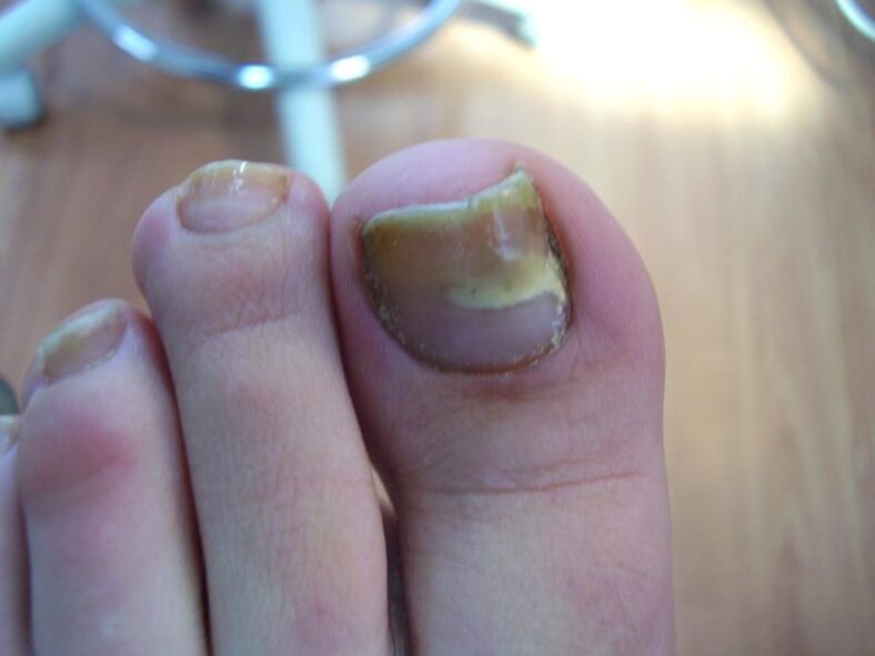 How to treat yellow nails caused by fungus with drops