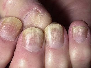 the fungus is under the nail