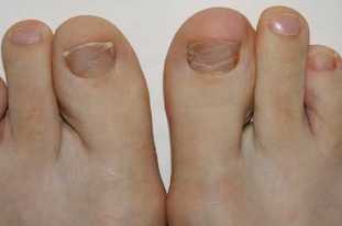 The first signs of the appearance of mold on your feet