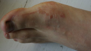 the fungus on the feet in the initial phase of the