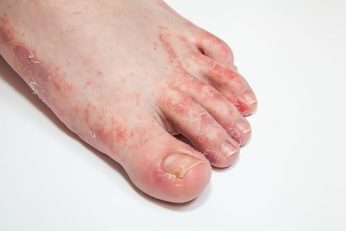 the fungus of the foot, and the nails